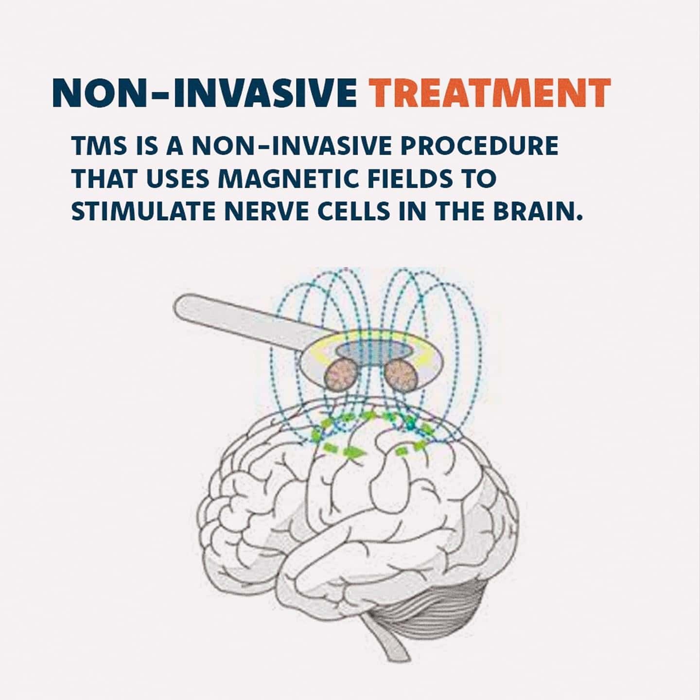 TMS is a non-invasive treatment